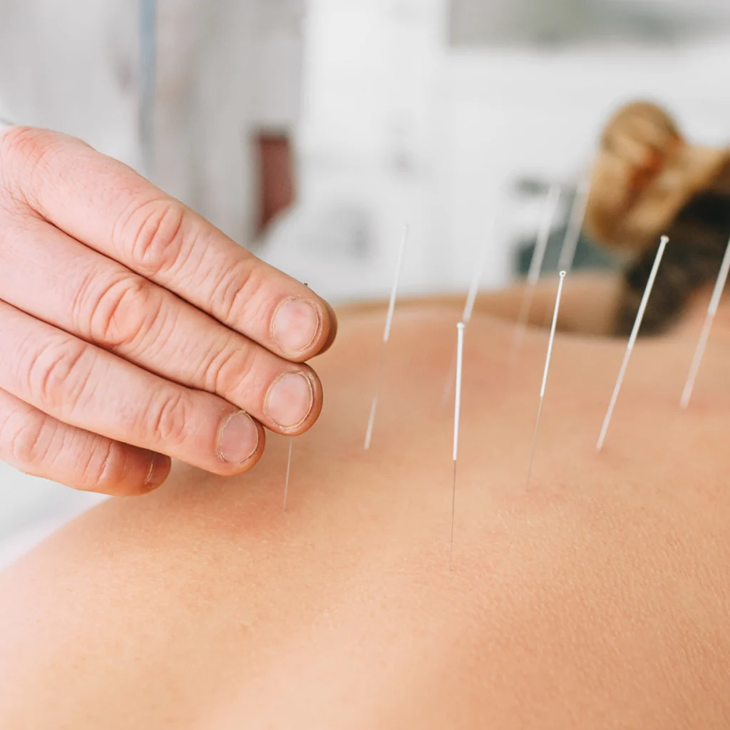 Aplicação técnica de agulhas de acupuntura em paciente durante atendimento profissional em Campinas.