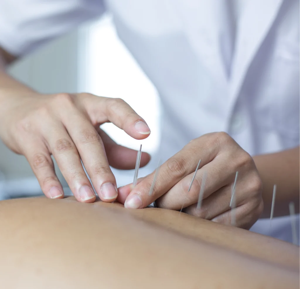 Aplicação detalhada de agulhas de acupuntura em paciente durante sessão de reabilitação física em Campinas.