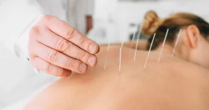 Aplicação técnica de acupuntura em paciente em Campinas, ilustrando o que é a terapia para alívio de dores.